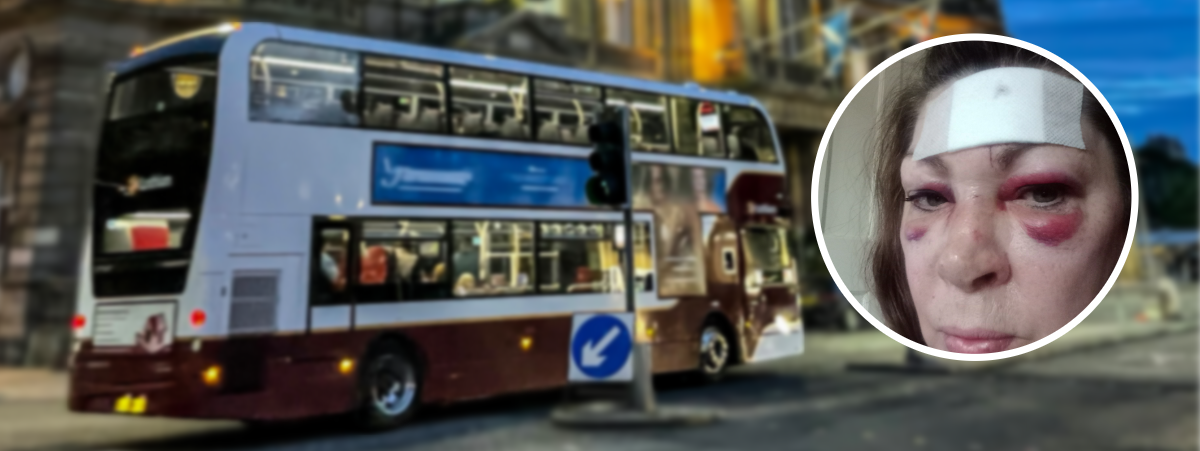 Gran awarded five-figure compensation after bus accident leaves scar