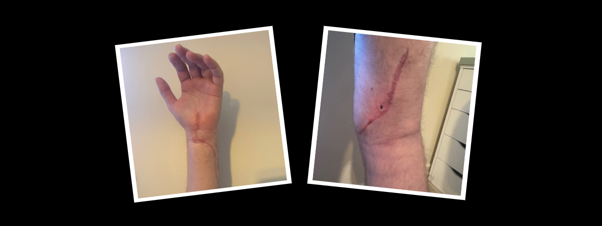 Images of Barry Evans' injuries to his left arm and leg showing scarring