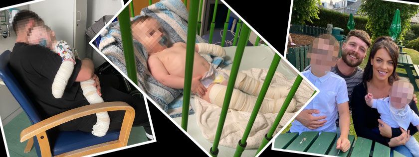Pictures of baby burn injuries and family