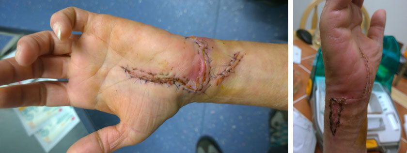 Image showing stiches required after dog bite