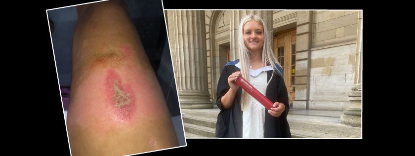 Nando’s worker seeks damages after detergent skin burn