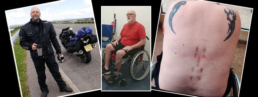 Gordon, an experienced biker, pictured next to his motorbike. Gordon then pictured in a wheelchair following the crash. A picture of Gordon's scarring following surgery to his back.