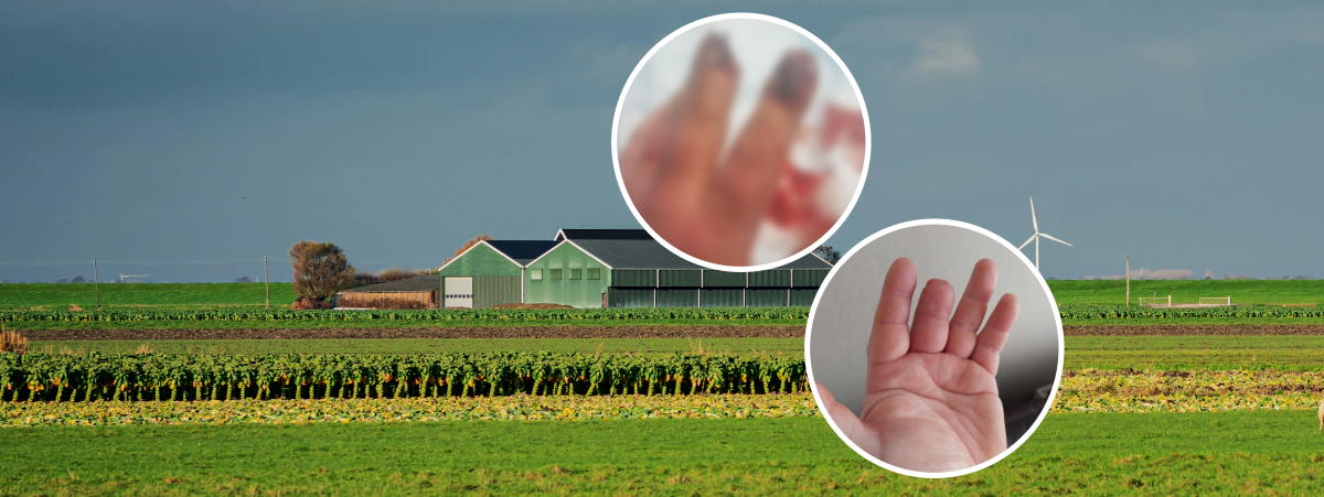 This picture shows a brussels sprout farm and has two pictures of our client's injuries within two white circles. The client lost half of their middle finger in an accident involving the blades in the brussels sprout harvester.