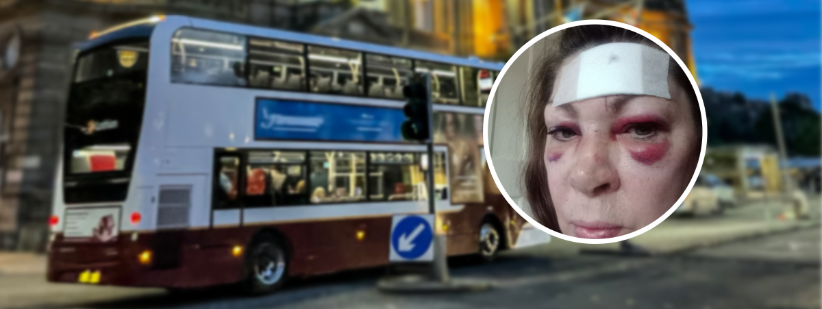 Gran awarded five-figure compensation after bus accident leaves scar
