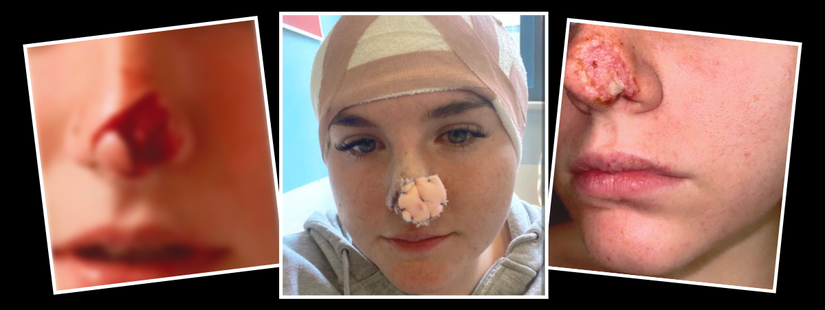 Three images showing the stages of recovery after a dog bit a carer's nose.