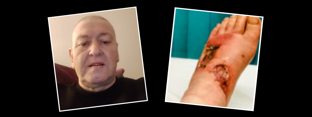 Thomas Cairns pictured on the left, his foot (blurred) burned by chemicals pictured on the right