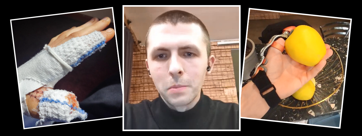 Image shows a black screen with three images which have white borders. The middle image is of a man named Arturs wearing a black top and black earphones. The left image shows Arturs left hand covered in bandages after losing his thumb. The right image shows Arturs using a prosthetic known as a Thumb Driver to lift an apple from a fruit bowl. This prosthetic was secured as part of his claim for compensation.
