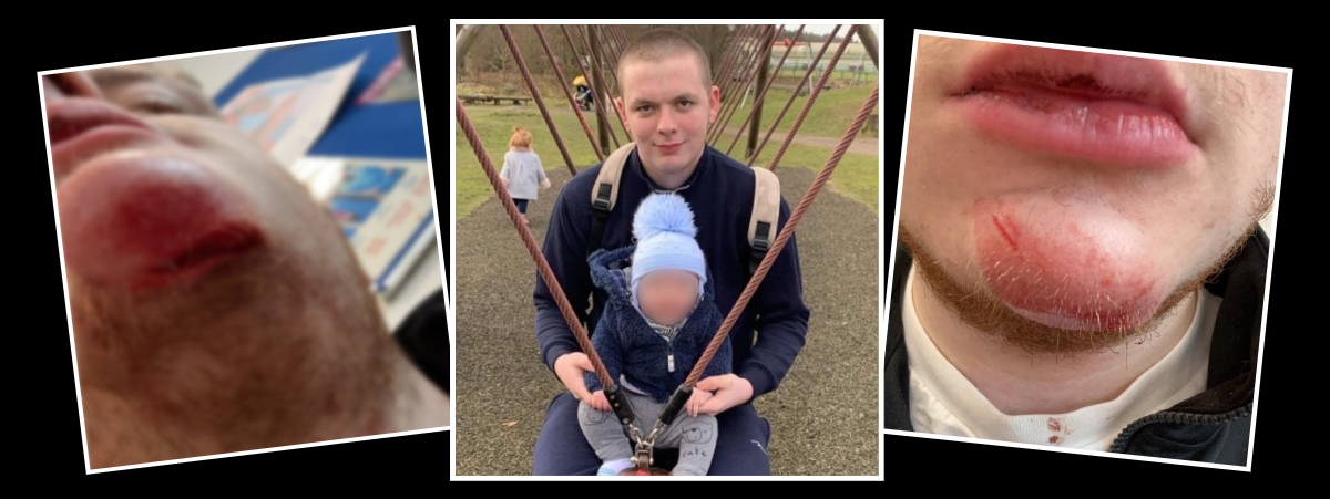 Image shows three white squares on a black background each filled with an image. The image on the left shows Josh's chin with a large, deep cut. The centre image shows Josh with his child sitting on a swing. The right image shows Josh's lower half of his face which is bashed and bruised.