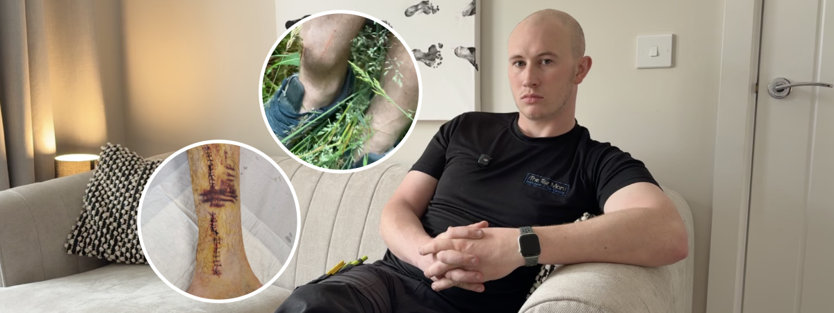 John pictured sitting on the couch in his living room looking directly to camera, the image is overlayed with two images within white circles. One is of John's leg immediately after his accident showing the lump that had formed on his leg. The other image shows the scar left on John's leg after surgery.