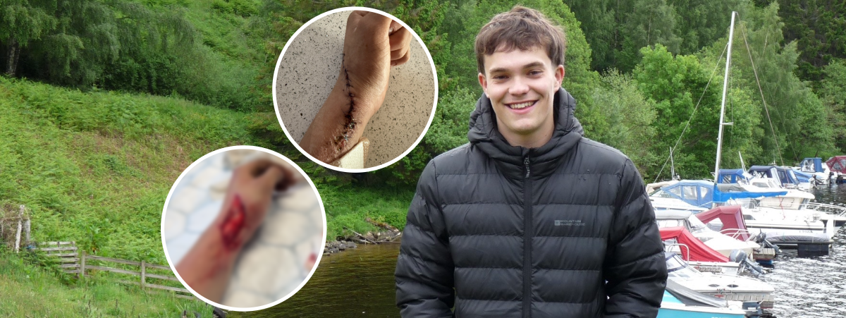 Lennon is pictured wearing a black puffer jacket against a woodland backdrop with sailboats on the water. There are two overlayed images showing the injury to his arm.