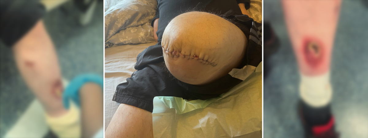 Image contains three images of our client's leg, two with a painful sore which have been blurred and the central image depicts the client's leg stitched following amputation.