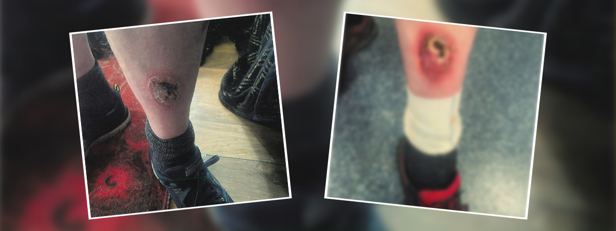 Images show Mr G's leg on the left with a large scab, the image on the right is blurred but shows his leg has worsened.