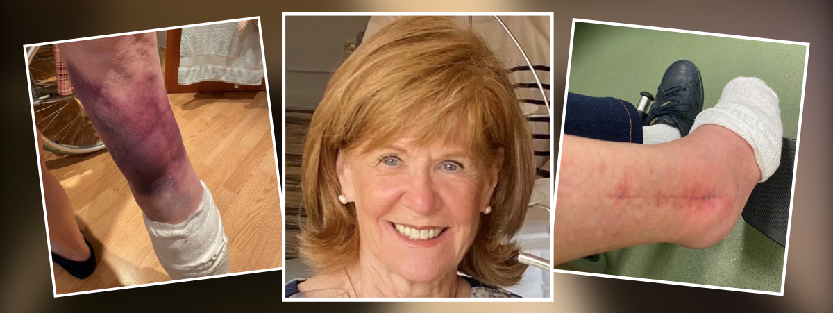 Liz Johnstone pictured in the centre smiling. On the left Liz' leg is shown heavily bruised. Her ankle is shown, swollen and with a long scar, in the image on the right.