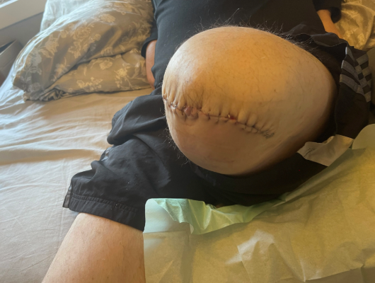 Image shows Mr G's leg following his amputation, it is healed and shows a line of stitches.