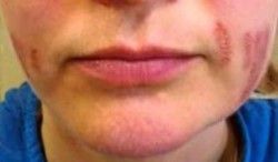 Fibroblast Facial Injury Burns and Scarring -  Client B second image