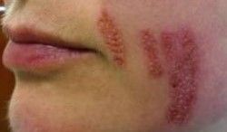 Fibroblast Facial Injury Burns and Scarring -  Client B