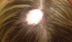 Hair Colouring Treatment Burns leaving Bald Patch - Client G