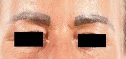 Semi Permanent Makeup Brow Injury - Client D