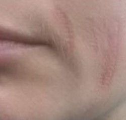 Fibroblast Facial Injury Burns and Scarring -  Client B fourth image