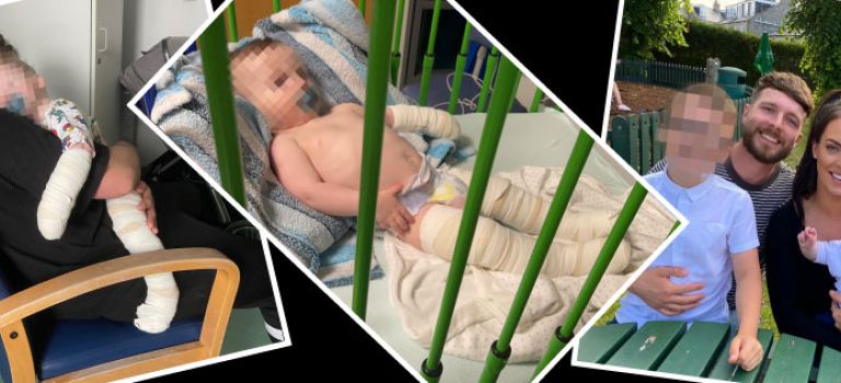 Pictures of baby burn injuries and family