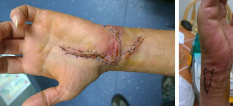 Image showing stiches required after dog bite