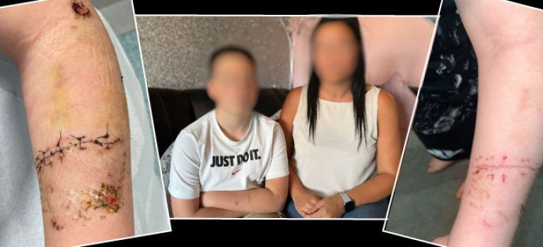 Schoolboy scarred for life after Rottweiler attack