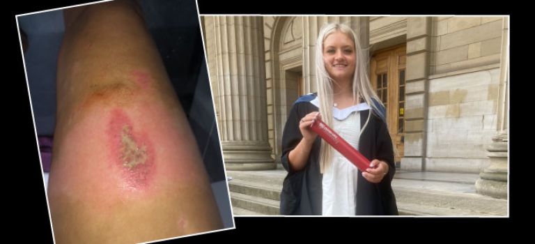 Nando’s worker seeks damages after detergent skin burn