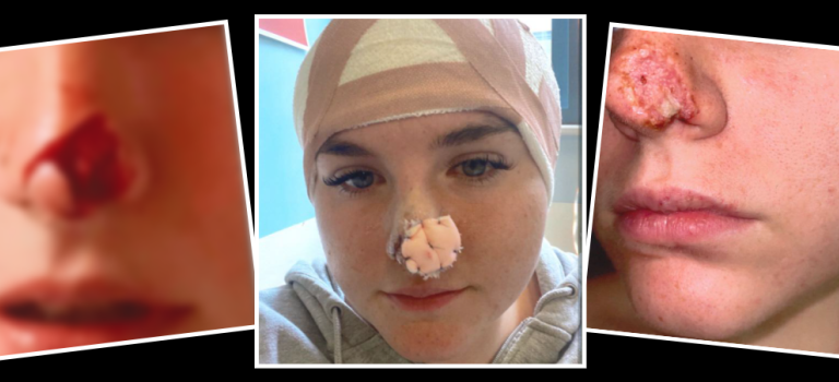 Three images showing the stages of recovery after a dog bit a carer's nose.