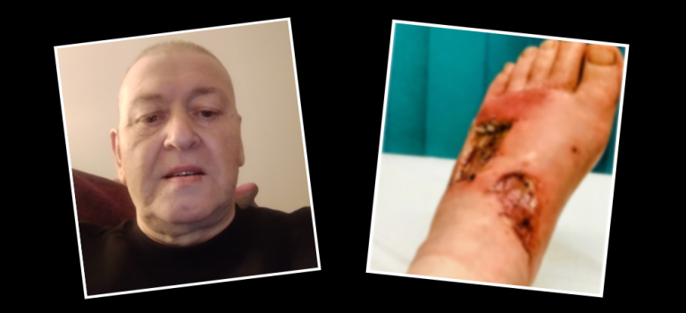 Thomas Cairns pictured on the left, his foot (blurred) burned by chemicals pictured on the right