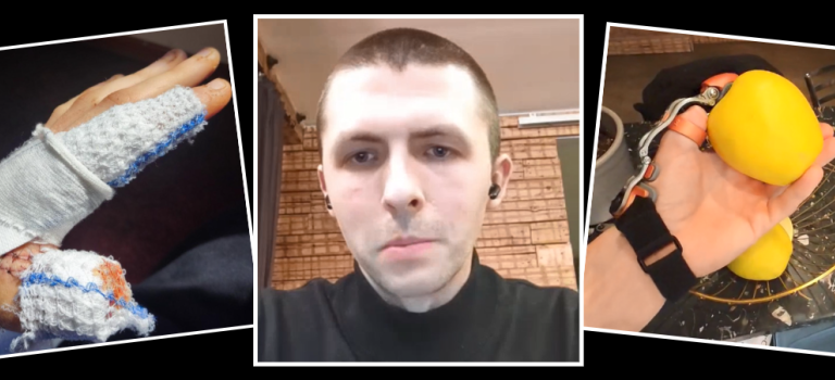 Image shows a black screen with three images which have white borders. The middle image is of a man named Arturs wearing a black top and black earphones. The left image shows Arturs left hand covered in bandages after losing his thumb. The right image shows Arturs using a prosthetic known as a Thumb Driver to lift an apple from a fruit bowl. This prosthetic was secured as part of his claim for compensation.