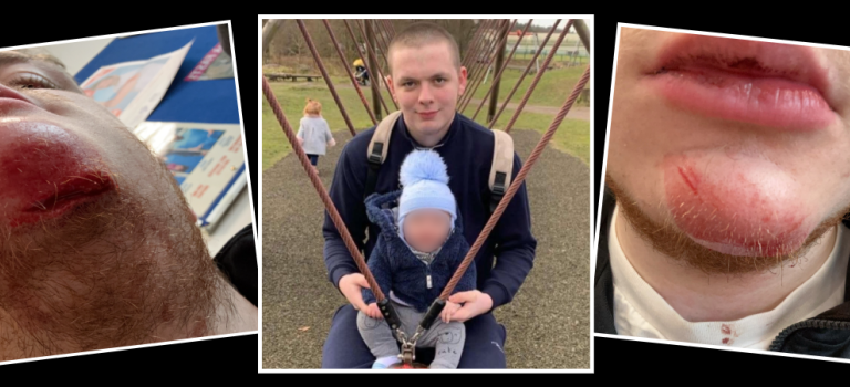 Image shows three white squares on a black background each filled with an image. The image on the left shows Josh's chin with a large, deep cut. The centre image shows Josh with his child sitting on a swing. The right image shows Josh's lower half of his face which is bashed and bruised.