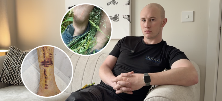 John pictured sitting on the couch in his living room looking directly to camera, the image is overlayed with two images within white circles. One is of John's leg immediately after his accident showing the lump that had formed on his leg. The other image shows the scar left on John's leg after surgery.