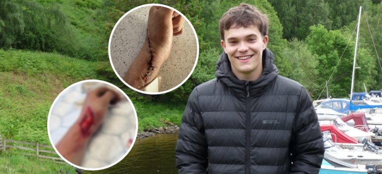 Lennon is pictured wearing a black puffer jacket against a woodland backdrop with sailboats on the water. There are two overlayed images showing the injury to his arm.