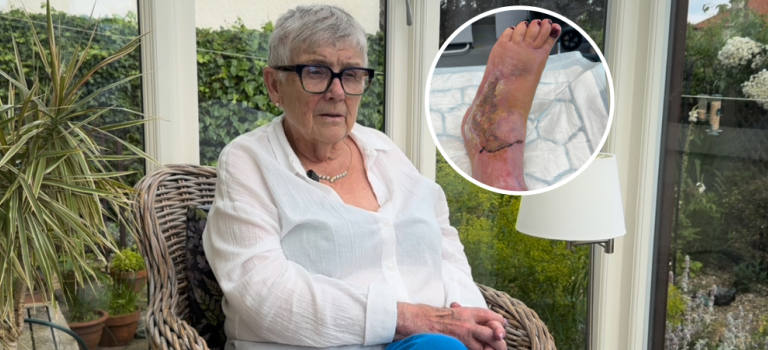 Image shows Anne sitting on a chair in her conservatory - there is an image overlayed to the right of her foot showing bruising and cuts after her fall.