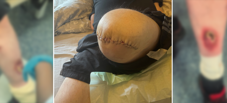 Image contains three images of our client's leg, two with a painful sore which have been blurred and the central image depicts the client's leg stitched following amputation.