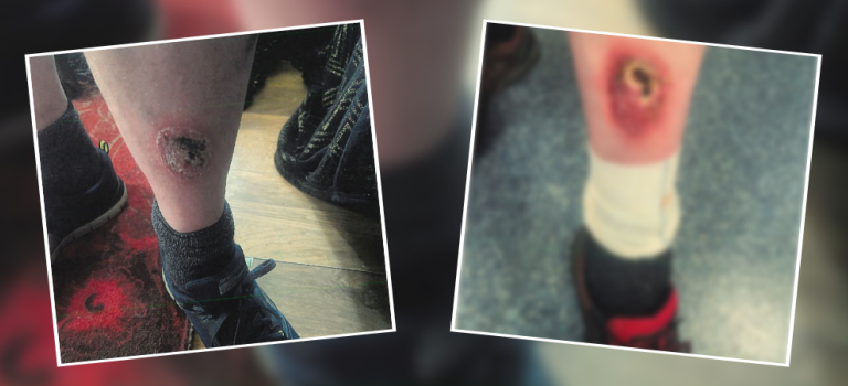 Images show Mr G's leg on the left with a large scab, the image on the right is blurred but shows his leg has worsened.