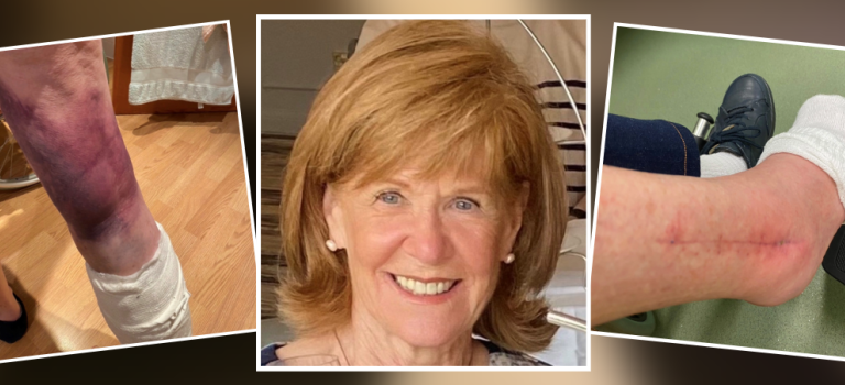 Liz Johnstone pictured in the centre smiling. On the left Liz' leg is shown heavily bruised. Her ankle is shown, swollen and with a long scar, in the image on the right.