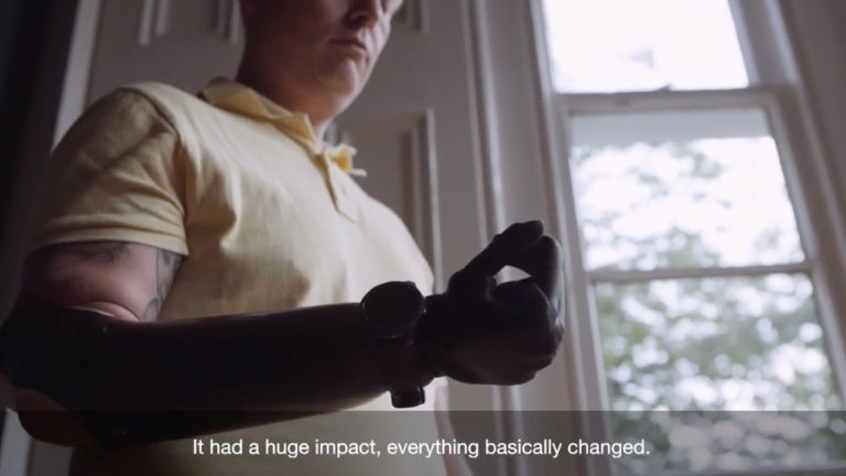 Ian McDonald with his prosthetic arm